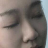 在成都魅麗經(jīng)緯做單眼皮變雙眼皮整形恢復(fù)過(guò)程和對(duì)比圖分享