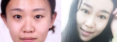 雙眼皮切割前后對比圖，單眼皮變雙眼皮整形恢復過程