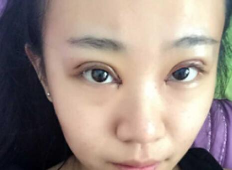 單眼皮變雙眼皮整形恢復過程和對比圖分享