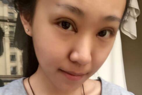 單眼皮變雙眼皮整形恢復過程和對比圖