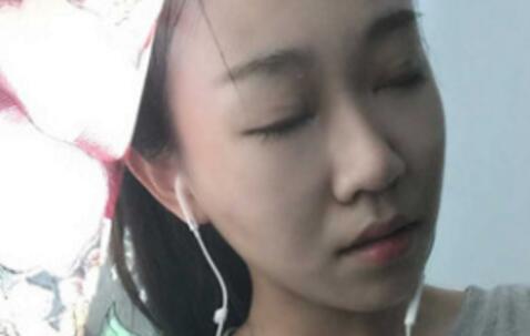 單眼皮變雙眼皮整形恢復過程和對比圖