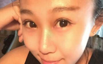 單眼皮變雙眼皮整形恢復過程和對比圖