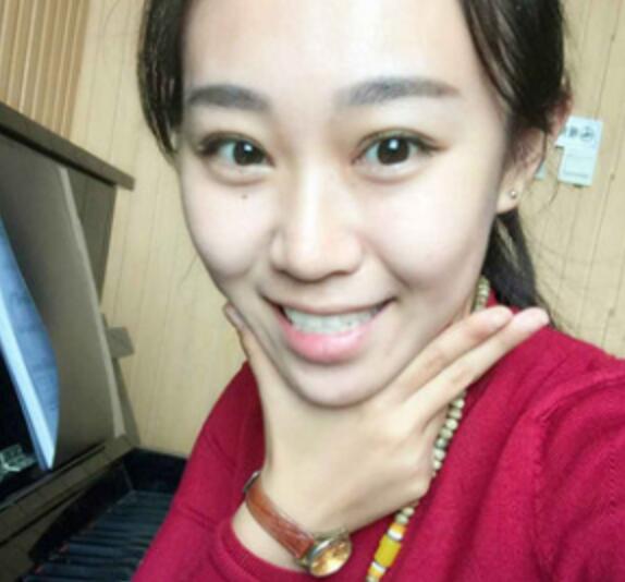 單眼皮變雙眼皮整形恢復過程和對比圖