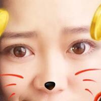 割雙眼皮前后對(duì)比圖和恢復(fù)過(guò)程——成都魅麗經(jīng)緯整形醫(yī)院