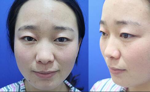 割雙眼皮前后對(duì)比圖和恢復(fù)過程