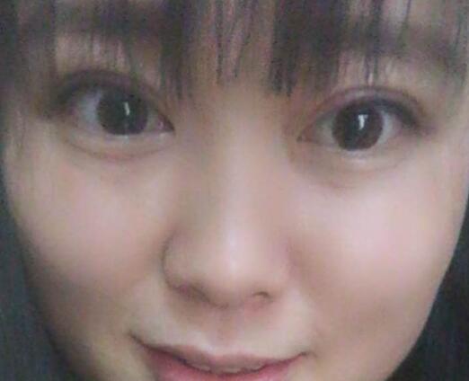 割雙眼皮前后對(duì)比圖和恢復(fù)過程