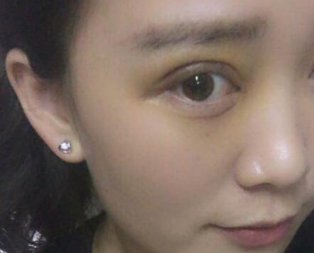 割雙眼皮前后對(duì)比圖和恢復(fù)過程