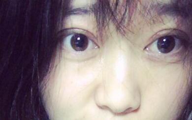 割雙眼皮前后對(duì)比圖和恢復(fù)過程