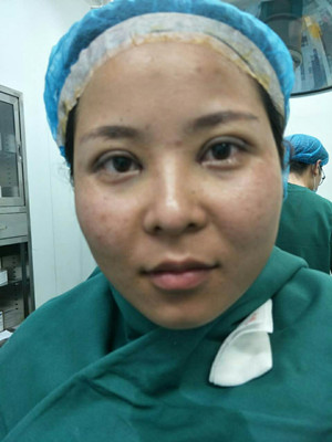 深圳南西子袁新平醫(yī)生做的割雙眼皮+開眼角前后恢復(fù)過程圖片分享