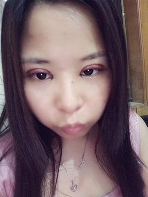 深圳南西子袁新平醫(yī)生做的割雙眼皮+開眼角前后恢復(fù)過程圖片分享