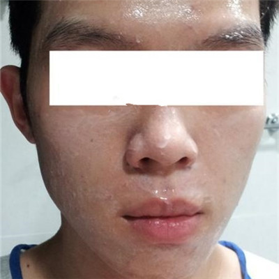 宜賓西嬋曾占權(quán)做祛痘一個月了，分享恢復(fù)果對比圖片~