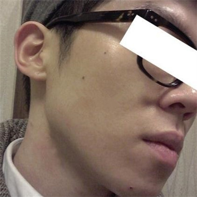 宜賓西嬋曾占權(quán)做祛痘一個月了，分享恢復(fù)果對比圖片~