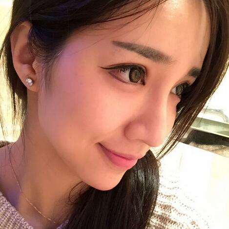 切開雙眼皮恢復(fù)過程分享 杭州東方做雙眼皮2個月