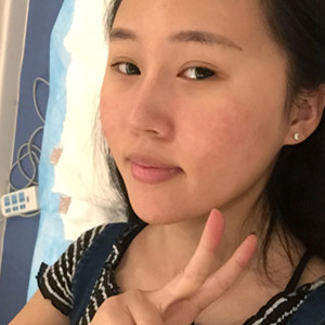 光子嫩膚手術前后過程以及對比照片分享，武漢美都朱紅霞醫(yī)生做的