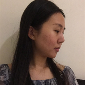 光子嫩膚手術前后過程以及對比照片分享，武漢美都朱紅霞醫(yī)生做的