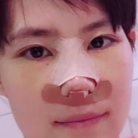 杭州悅可整形醫(yī)院做隆鼻失敗修復(fù)恢復(fù)過(guò)程和對(duì)比圖分享