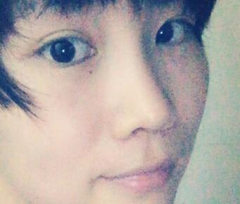 杭州悅可整形醫(yī)院做隆鼻失敗修復(fù)恢復(fù)過(guò)程和對(duì)比圖分享