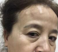 去抬頭紋方法？杭州悅可整容推薦注射瘦臉去抬頭紋魚尾紋