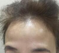 去抬頭紋方法？杭州悅可整容推薦注射瘦臉去抬頭紋魚尾紋