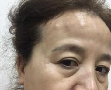 去抬頭紋很好的方法？注射瘦臉去抬頭紋魚尾紋