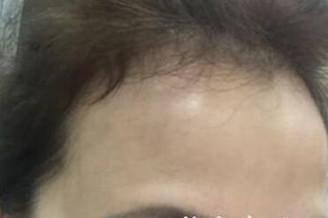 去抬頭紋很好的方法？注射瘦臉去抬頭紋魚尾紋