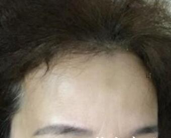 去抬頭紋很好的方法？注射瘦臉去抬頭紋魚尾紋