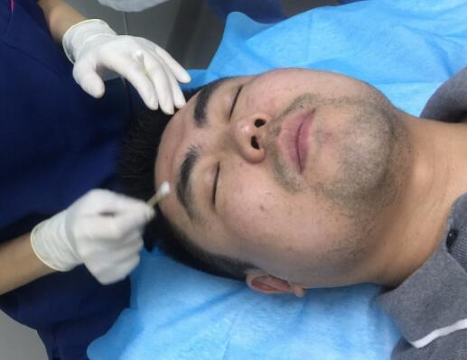 男生注射注射瘦臉去除抬頭紋魚尾紋案例分享