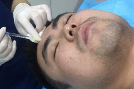 男生注射注射瘦臉去除抬頭紋魚尾紋案例分享