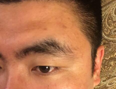 男生注射注射瘦臉去除抬頭紋魚尾紋案例分享