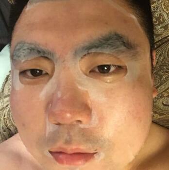 男生注射注射瘦臉去除抬頭紋魚尾紋案例分享