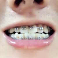 牙齒排列不整齊，在成都圣貝牙科醫(yī)院做了牙齒正畸矯正緩解