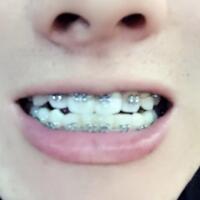 牙齒排列不整齊，在成都圣貝牙科醫(yī)院做了牙齒正畸矯正緩解