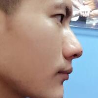 牙齒排列不整齊，在成都圣貝牙科醫(yī)院做了牙齒正畸矯正緩解