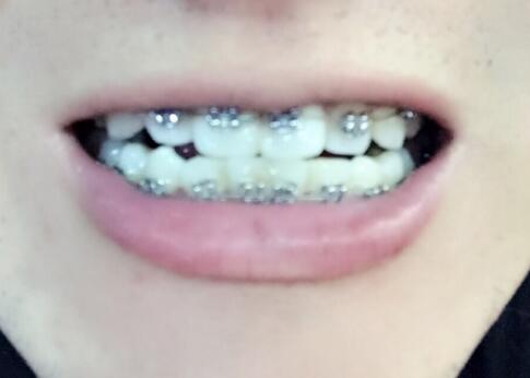 在成都圣貝牙科醫(yī)院做了牙齒正畸矯正緩解
