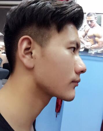 在成都圣貝牙科醫(yī)院做了牙齒正畸矯正緩解