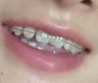 戴隱形牙套矯正牙齒前后對(duì)比圖——成都圣貝牙科醫(yī)院