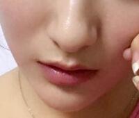 戴隱形牙套矯正牙齒前后對(duì)比圖——成都圣貝牙科醫(yī)院