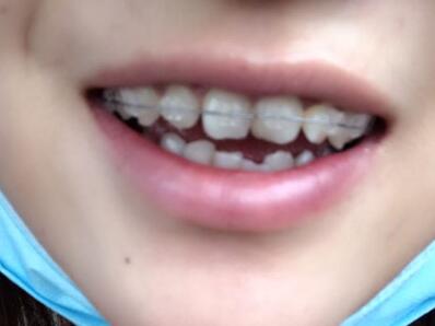 戴隱形牙套矯正牙齒前后對比圖——成都圣貝牙科醫(yī)院