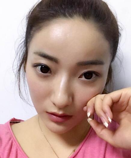 戴隱形牙套矯正牙齒前后對比圖——成都圣貝牙科醫(yī)院