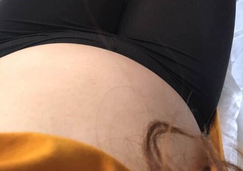 抽脂減肥瘦腰腹手術(shù)價格1.3w真實(shí)案例前后對比圖