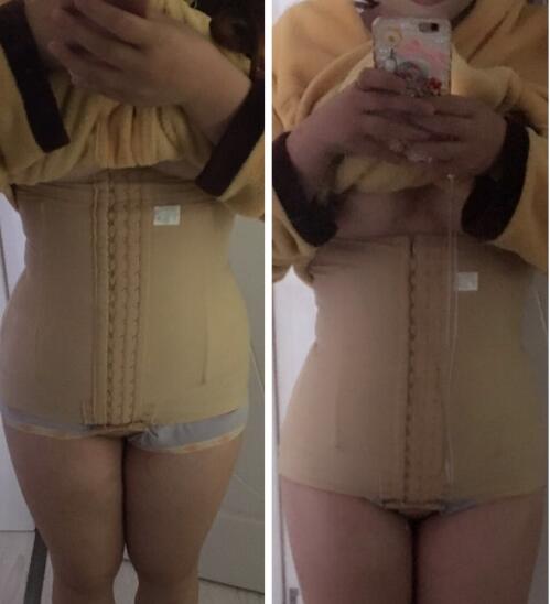 抽脂減肥瘦腰腹手術(shù)價格，真實(shí)案例前后對比圖