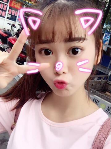 韓式微創(chuàng)雙眼皮恢復(fù)圖 深圳妍熙雙眼皮半年