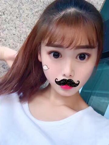 韓式微創(chuàng)雙眼皮恢復(fù)圖 深圳妍熙雙眼皮半年