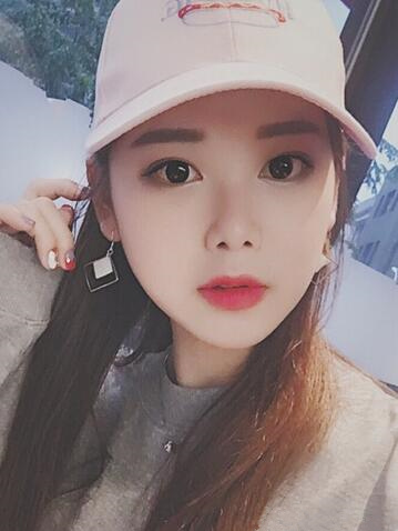 韓式微創(chuàng)雙眼皮恢復(fù)圖 深圳妍熙雙眼皮半年