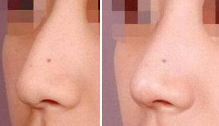 駝峰鼻矯正前后對比圖，鼻子整形圖片