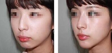 鷹鉤鼻整形前后對比圖