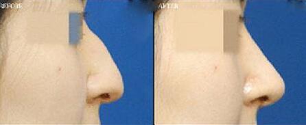 鷹鉤鼻整形前后對比圖