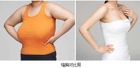 巨乳如何縮?。烤薮笕榉靠s小需要注意什么？