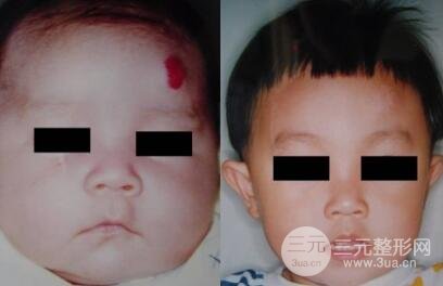 激光去胎記能去干凈嗎？會(huì)不會(huì)留疤？