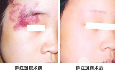 激光去胎記要多少錢(qián)?